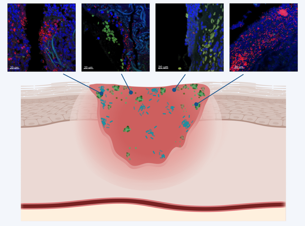 Schematic drawing of a chronic wound 